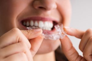 sure smile clear aligners