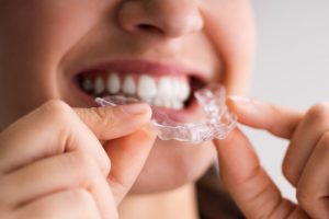 Woman holding clear aligners